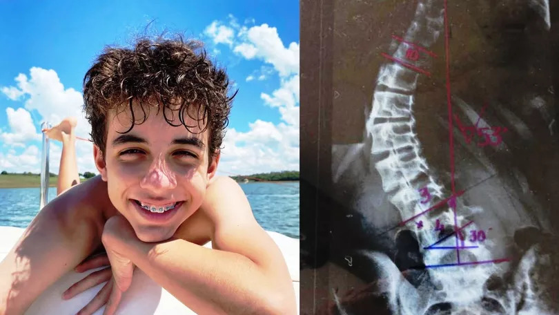 Raphael Henrique Franco Grosso, de 13 anos, foi diagnosticado com Escoliose Toracolombar Progressiva, durante uma consulta de rotina. - Foto: Arquivo Pessoal