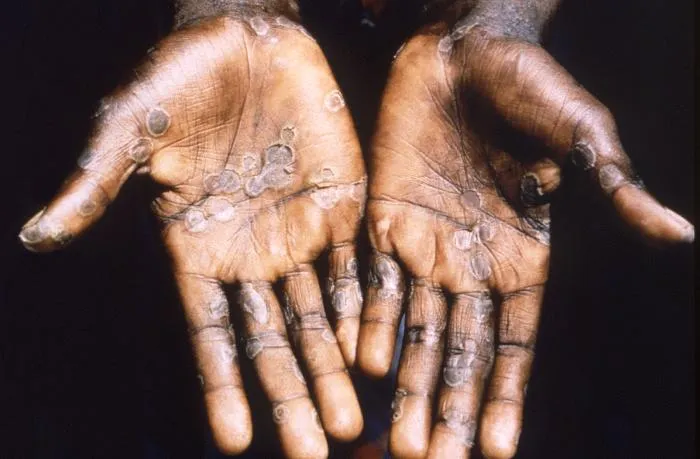 Foto tirada em 1997, durante um surto de casos da varíola dos macacos | Foto: CDC/Brian W.J. Mahy