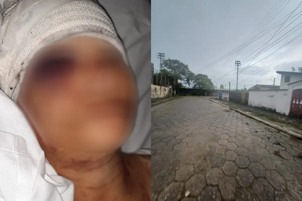 Mulher fica gravemente ferida após ser atacada por cão pitbull na última sexta-feira (25) em Mongaguá, SP  Foto: Reprodução/g1 Santos