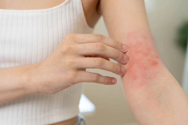 Manchas roxas pelo corpo são um sinal da doença. Crédito: Shutterstock