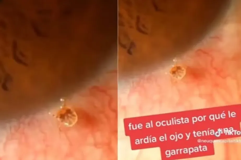 Carrapato é encontrado dentro do olho de paciente na Patagônia - foto: Reprodução/TikTok