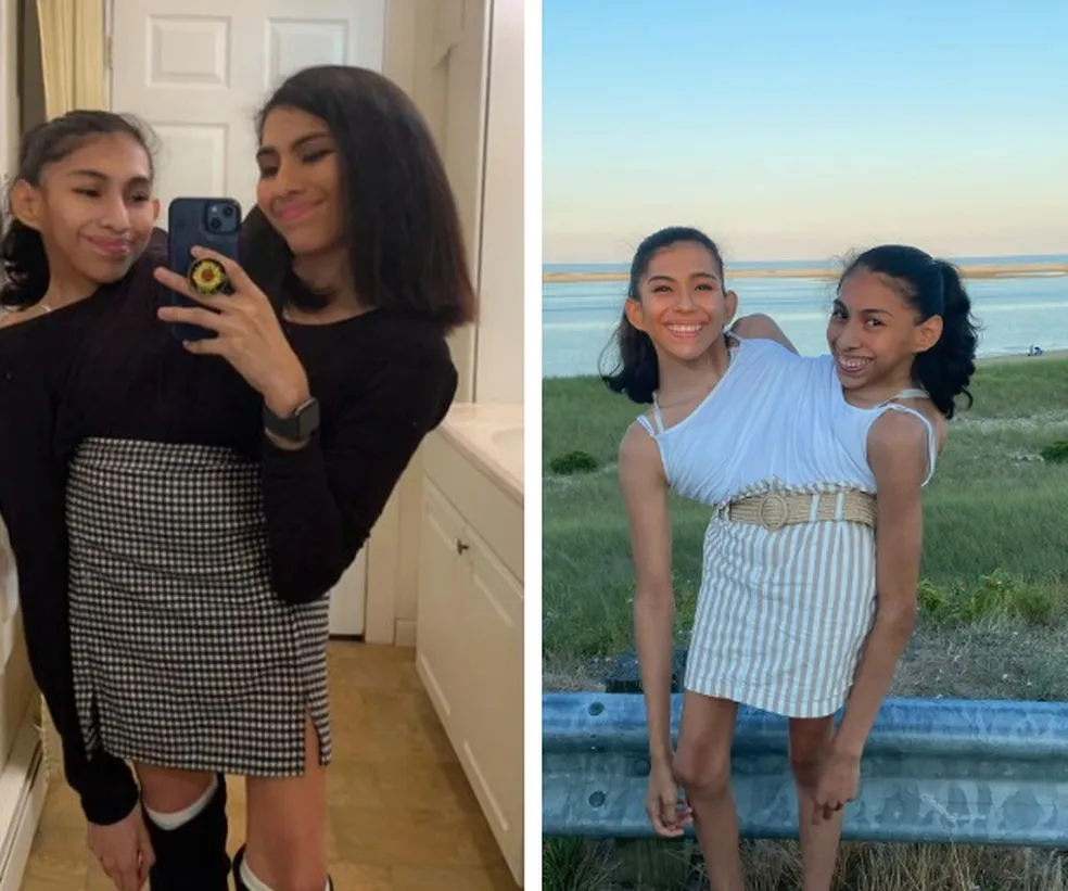 As irmãs siamesas dividem o mesmo torso - Foto: Reprodução/Instagram