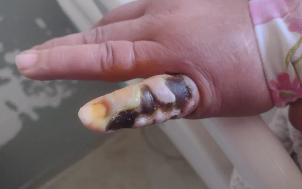 Mulher que teve o dedo picado por aranha vai precisar passar por cirurgia para retirar pele necrosada em MG - Foto: Arquivo pessoal