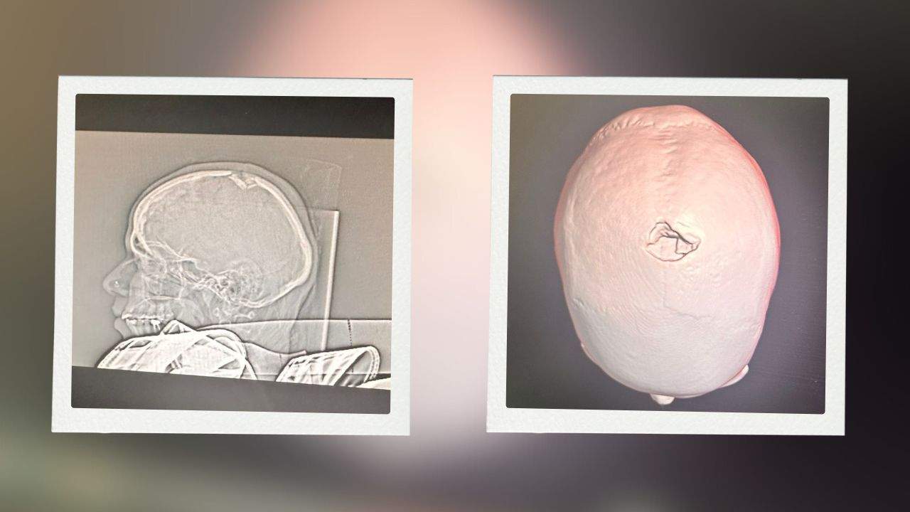 Foto: Reprodução / Arquivo Pessoal/Exame identificou que ela teve uma fratura no crânio, que está provocando pressão no cérebro