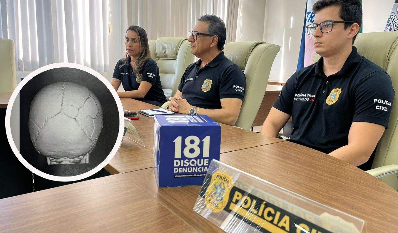 Foto: Divulgação/Sesp/Exame de imagem mostrou lesões no crânio da criança, segundo a Polícia Civil