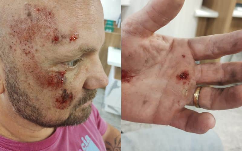 O professor Felipe Dallorto sofreu acidente após ser atingido por madeira na ciclovia. Foto: Divulgação (acervo pessoal)